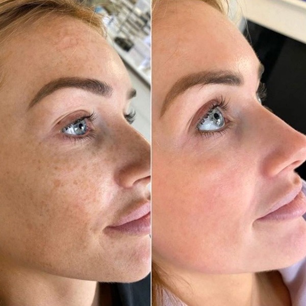 The Best Treatment for Face Pigmentation Removal Cosmelan The Brow